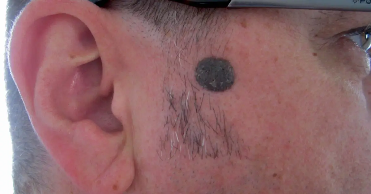 Обережно, родимка: розкрито прикмети можливих загроз