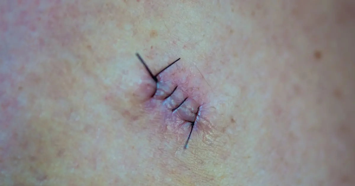 шрам після видалення родимки