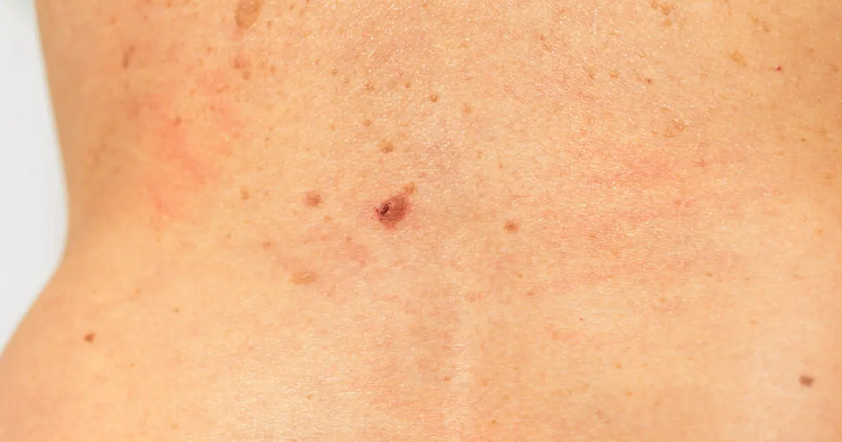 родимки на спині